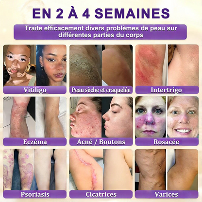 Fabriquée et expédiée depuis la France 🍁 Crème réparatrice pour la peau à la biotine Purelora® (formule 10-en-1) — Dernier jour de la promotion : -25 %.