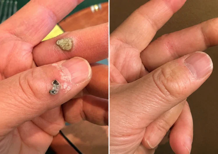 ✨Patch 2-en-1 Curalona® : Microneedle & Hydrocolloïde🍀 | Élimine les grains de beauté en relief, les verrues planes et les acrochordons | Aide à atténuer les rides, les cicatrices et les imperfections | Patch invisible adapté au visage et au corps（副本）